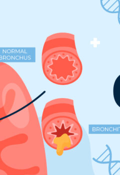 End-Stage COPD: What Are the Treatment Options Beyond Oxygen?