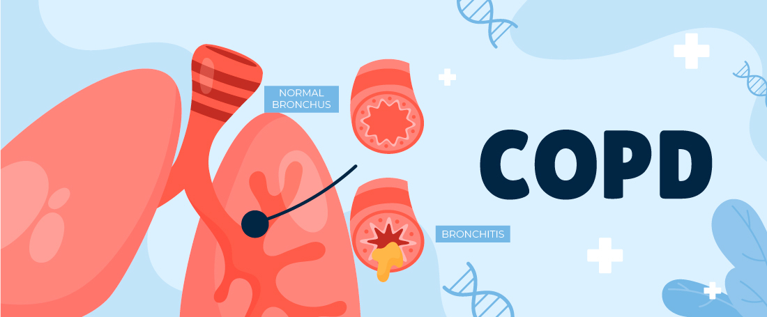 End-Stage COPD: What Are the Treatment Options Beyond Oxygen?